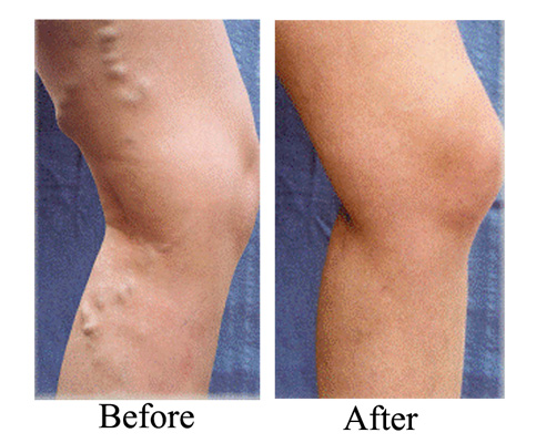 varicoseveins treatment